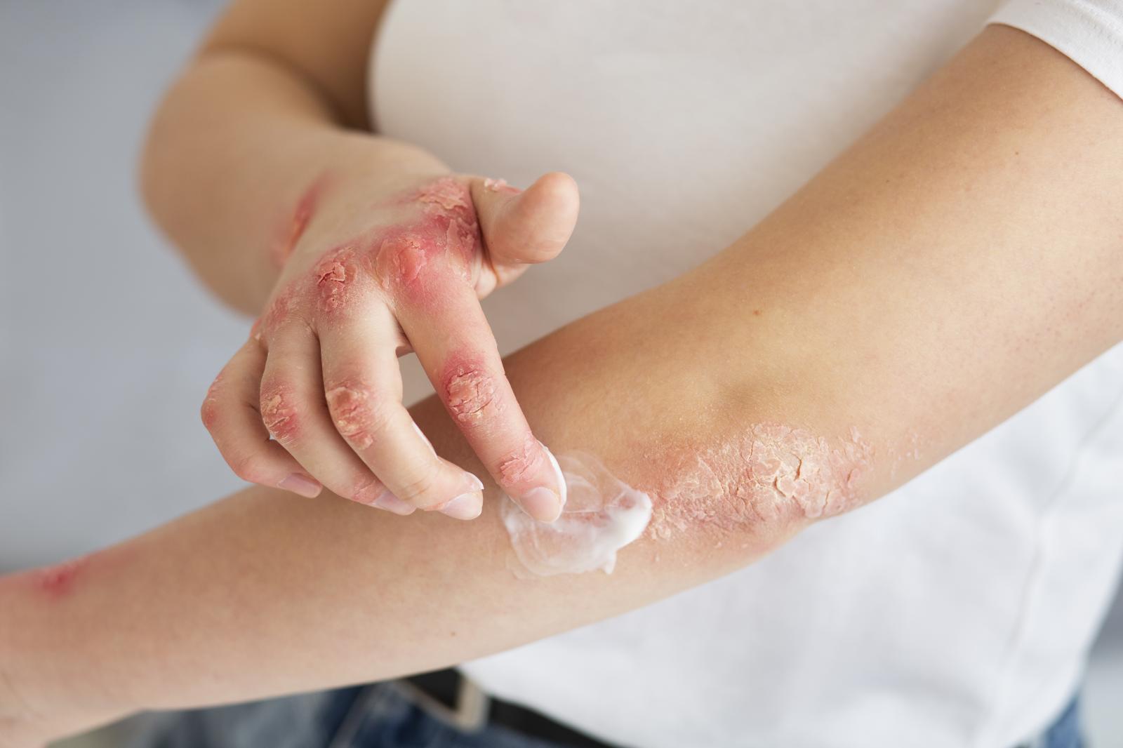 6 Cara Mengobati Herpes dengan Tepat
