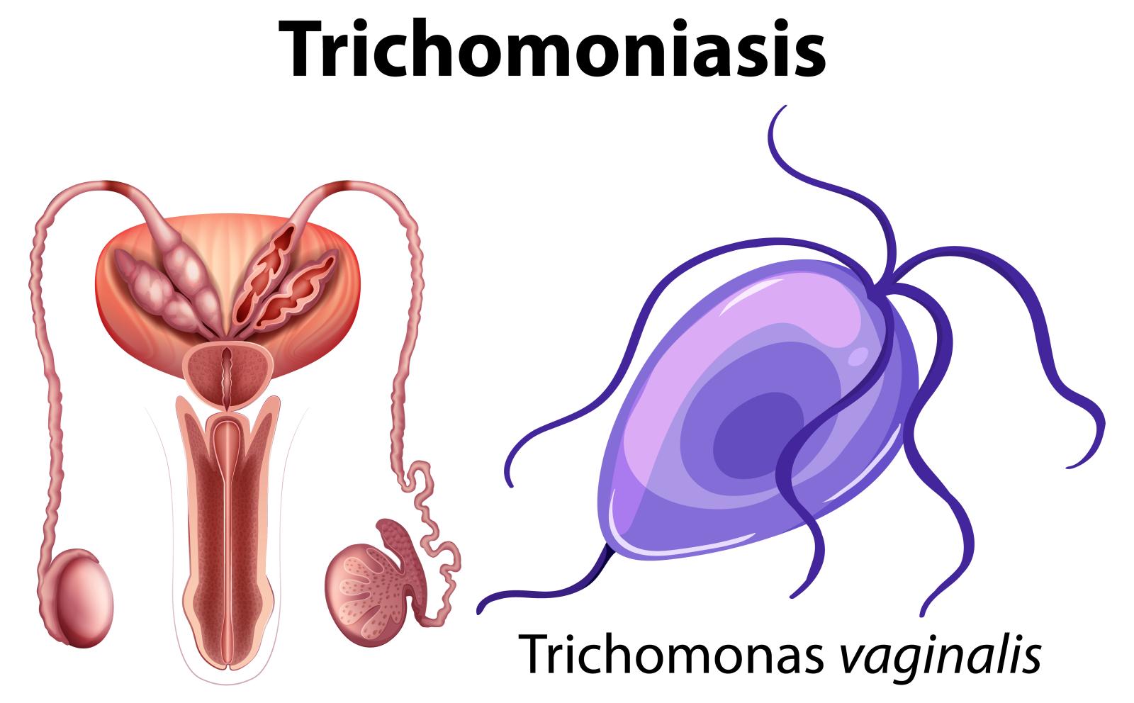 Trikomoniasis: Gejala, Penyebaran, dan Penanganannya