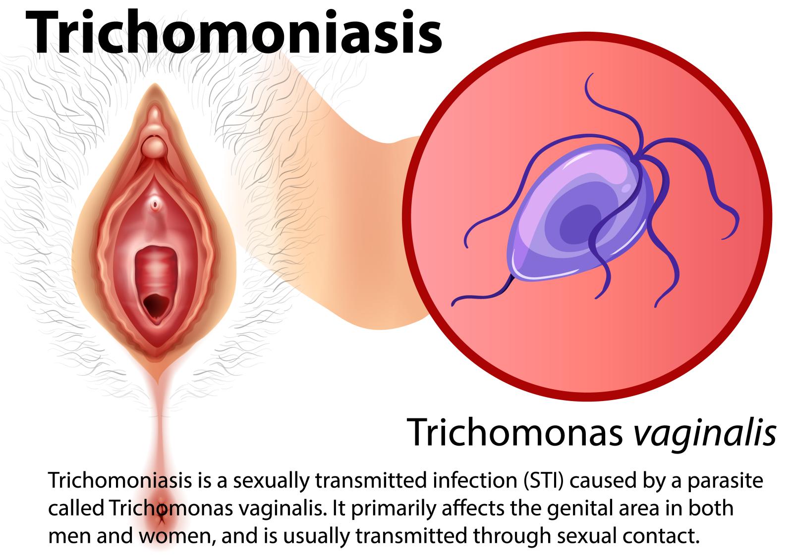 Langkah Pengobatan Trikomoniasis dan Tipsnya Agar Lebih Efektif